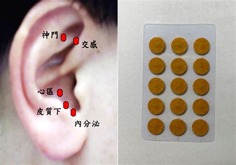 耳穴貼是什麼|﻿耳穴療法的臨床應用